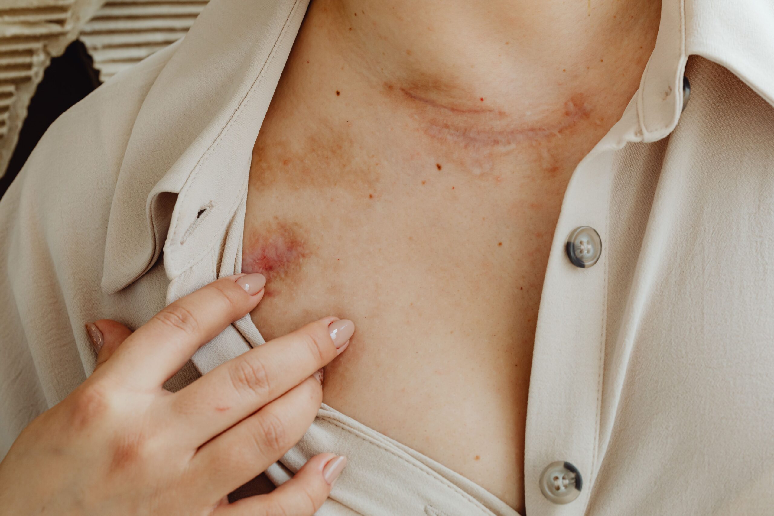 Ljubičasti osip može ukazivati na dermatomiozitis kod žena – ljubicasti osip kod žena