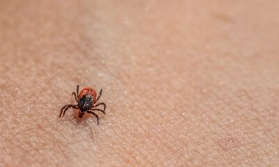 Iznenadna alergija na meso i mleko promenila život žene iz Misurija – alfa-gal sindrom