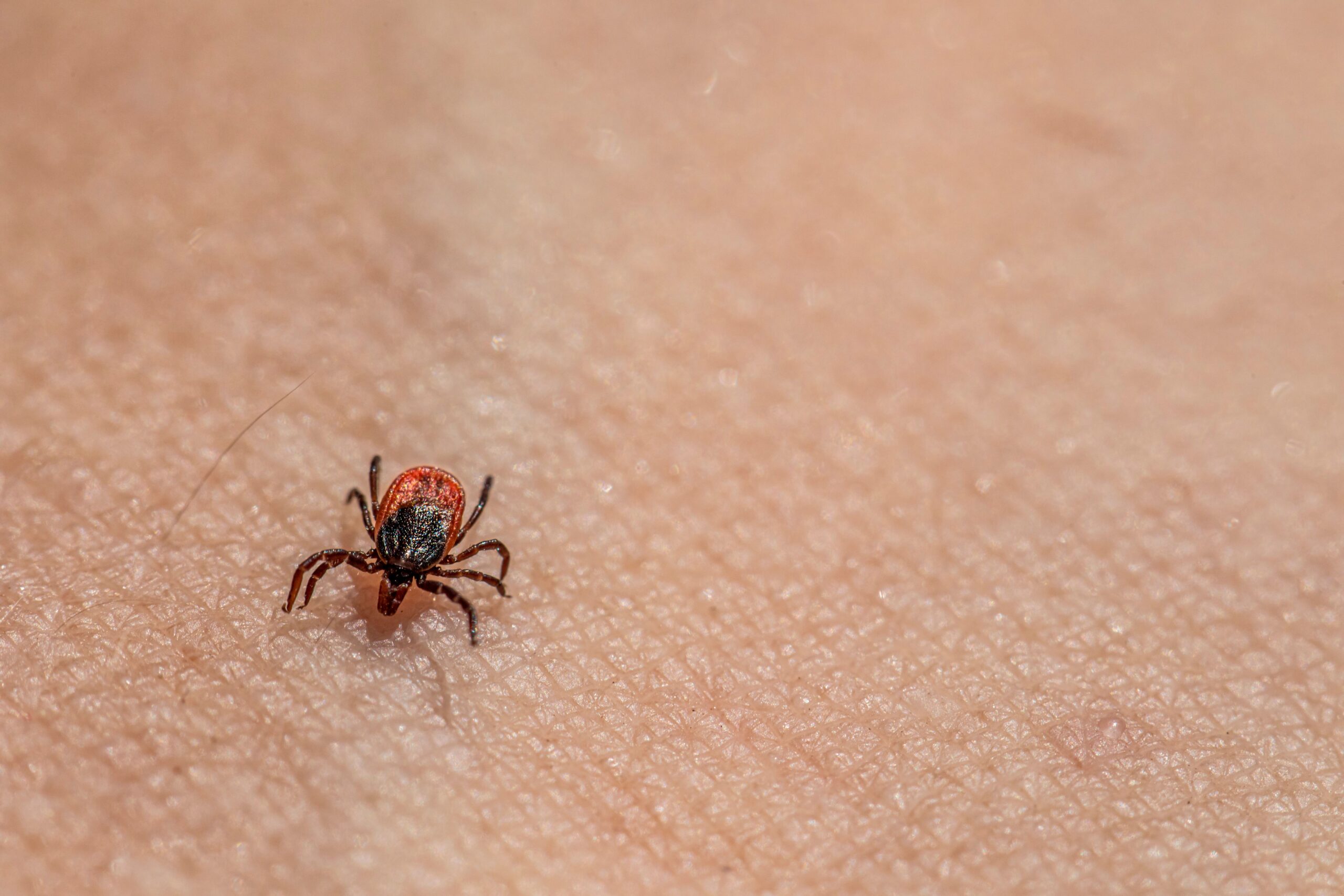 Iznenadna alergija na meso i mleko promenila život žene iz Misurija – alfa-gal sindrom