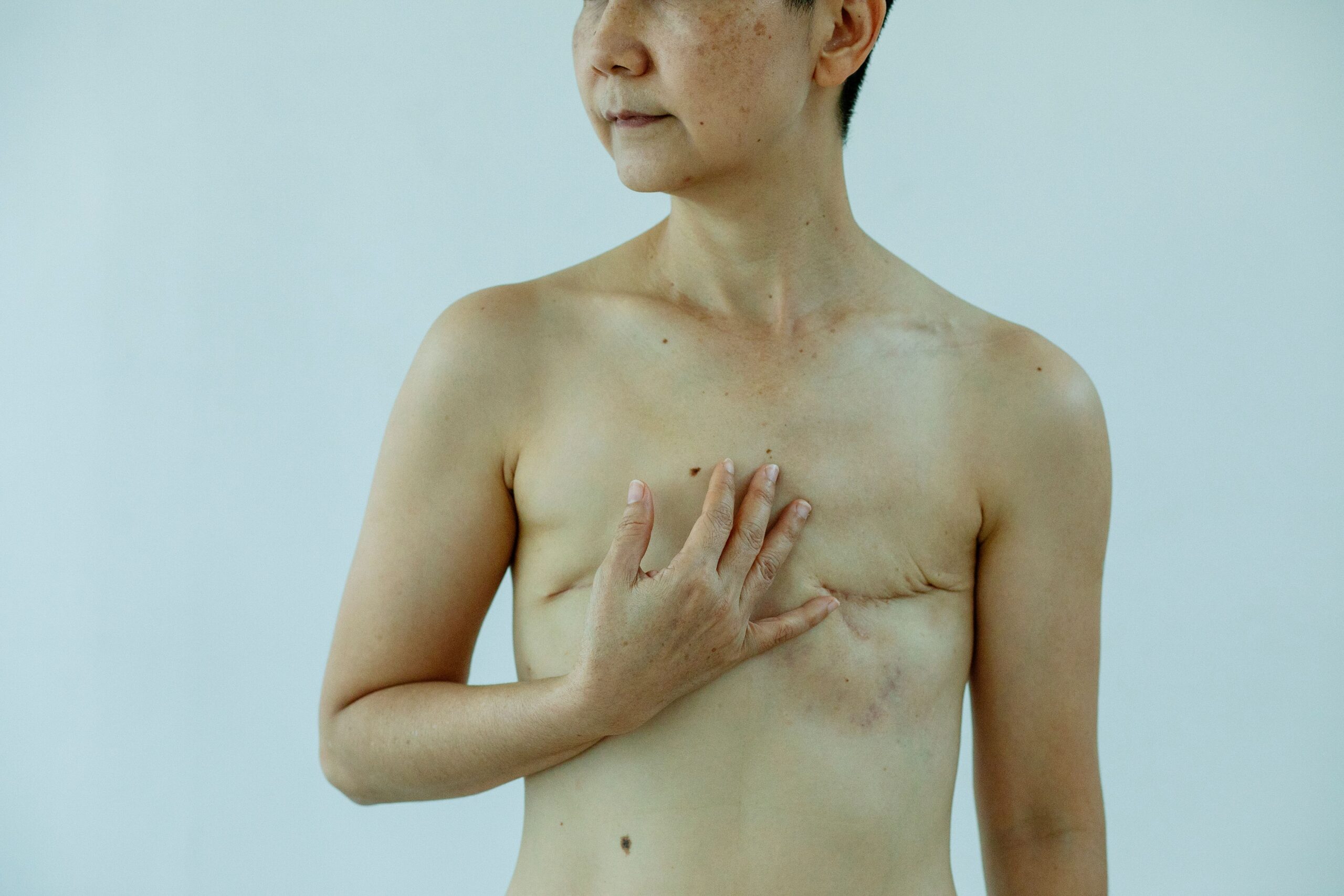 Novi pristup lečenju uznapredovalog melanoma kože donosi nadu ženama – uznapredovali melanom kože