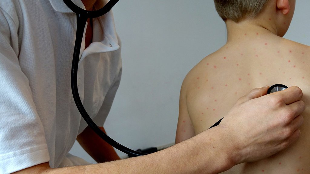 Male boginje u Srbiji: Zašto je važno obratiti pažnju na vakcinaciju dece
