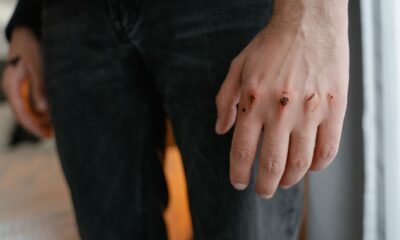 Ranica na ruci koja ne prolazi: Važan znak za zdravlje žena