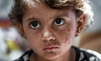 Epidemija malih boginja u Bangladešu dovela do skoro 1.000 preminulih