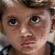 Epidemija malih boginja u Bangladešu dovela do skoro 1.000 preminulih