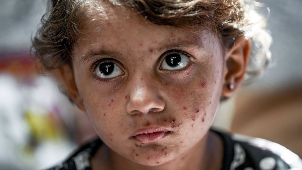 Epidemija malih boginja u Bangladešu dovela do skoro 1.000 preminulih