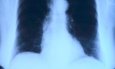 x-ray image, roentgen, thorax, lung x-ray, medicine, roentgen, roentgen, roentgen, roentgen, roentgen