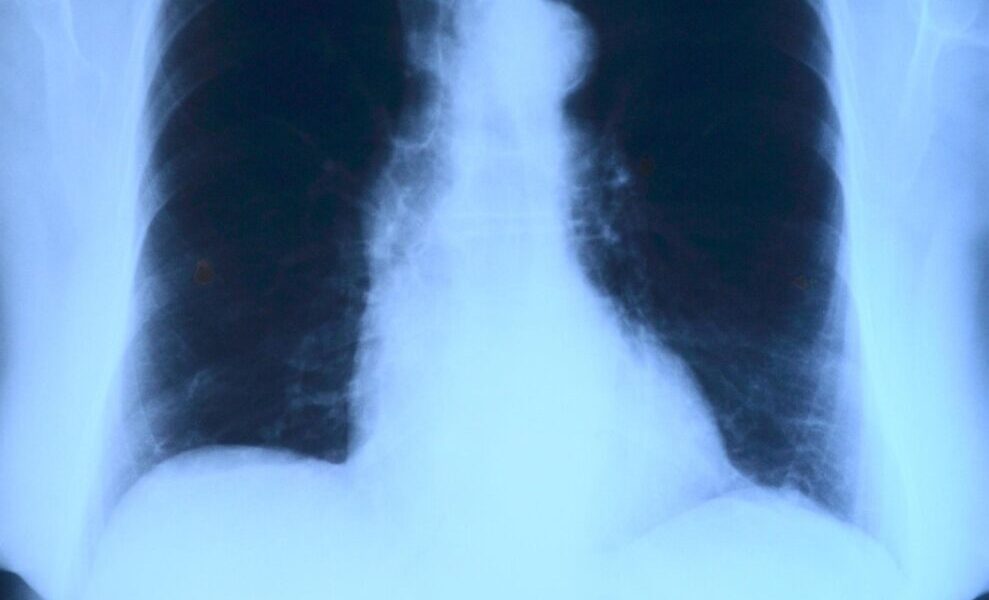 x-ray image, roentgen, thorax, lung x-ray, medicine, roentgen, roentgen, roentgen, roentgen, roentgen