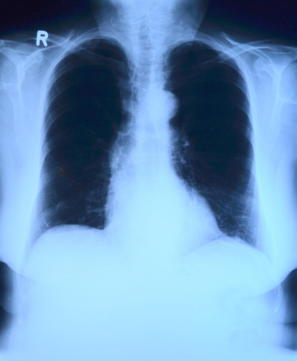 x-ray image, roentgen, thorax, lung x-ray, medicine, roentgen, roentgen, roentgen, roentgen, roentgen