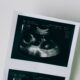 Genetski pregled embriona sve češći izbor među ženama