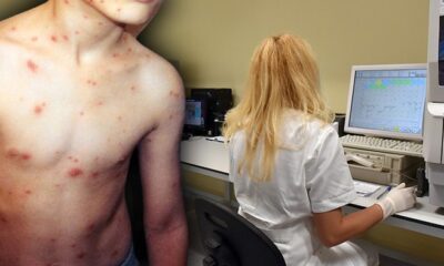Pacijent preminuo od majmunskih boginja u Španiji: Sumnja na bolničku zarazu otvara pitanja