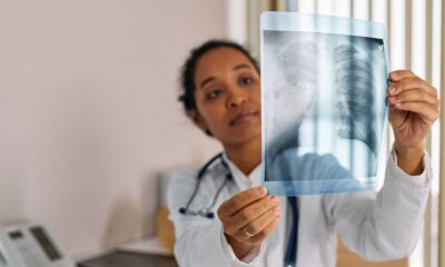 Adenokarcinom pluća može pogoditi i žene koje nisu pušile