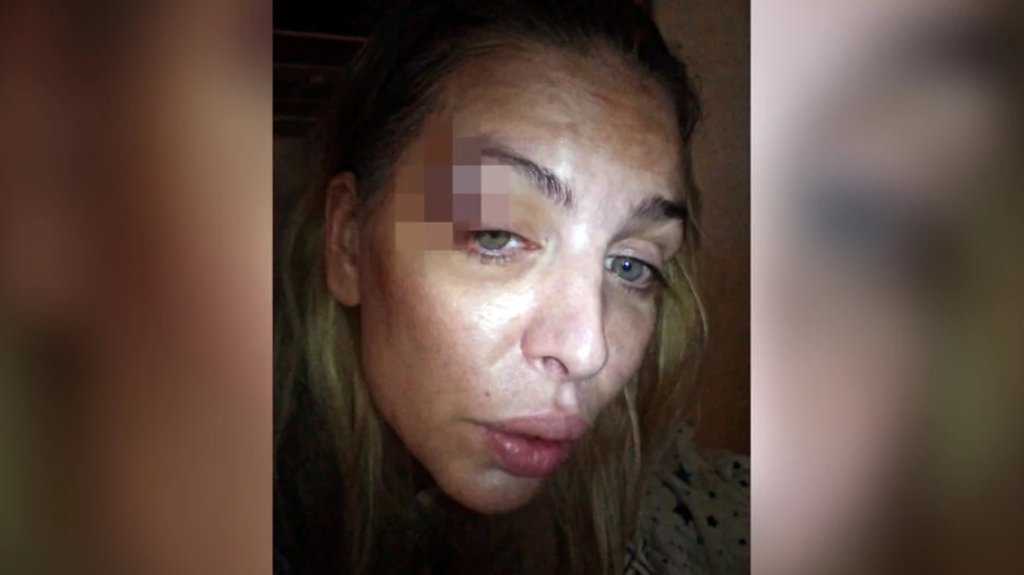 PONOVO U CENTRU PAŽNJE ZBOG INCIDENTA: Ava Karabatić završila u bolnici, objavila fotografiju povrede (FOTO) – napad u Beogradu